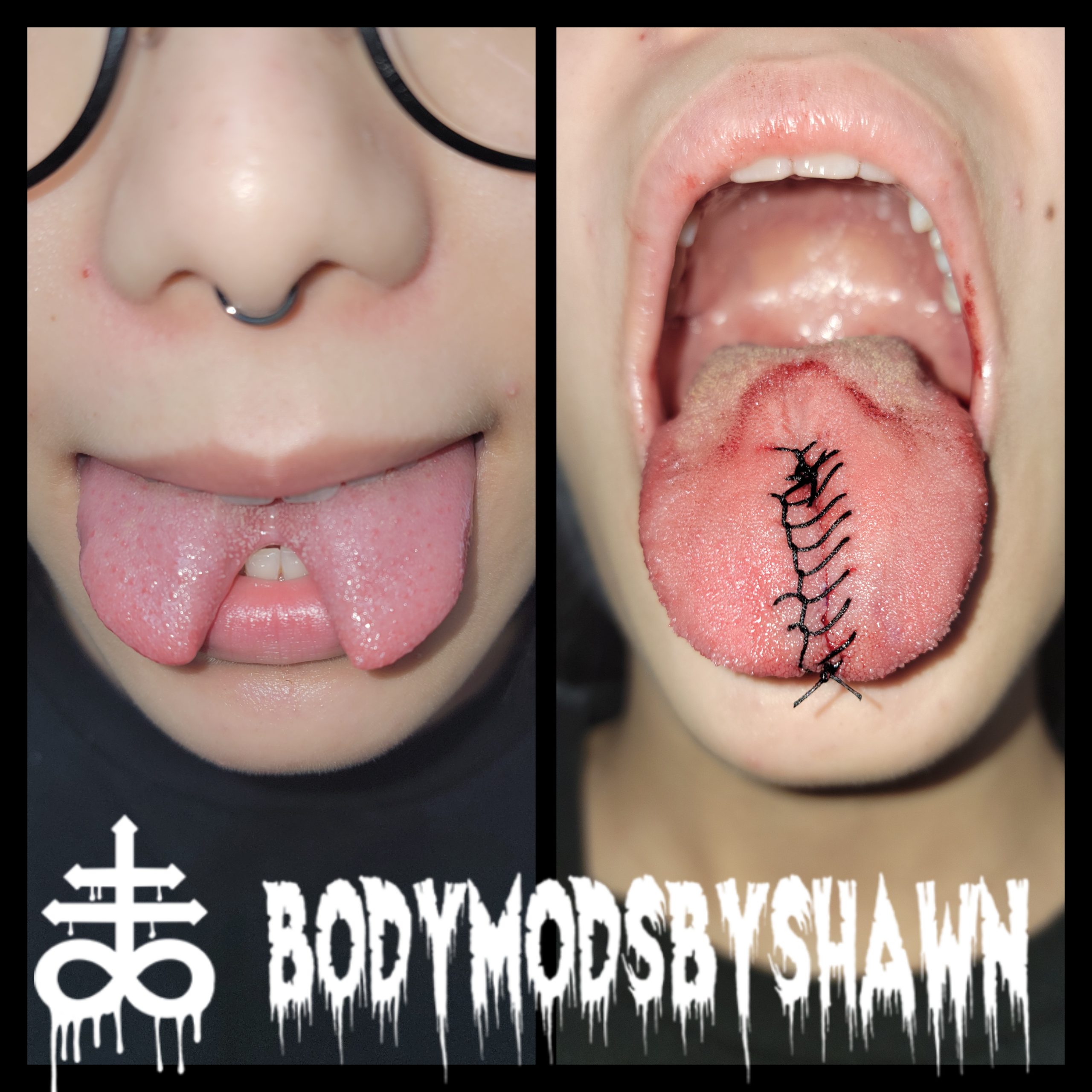 Tongue Split Reversal Body Mods By Shawn