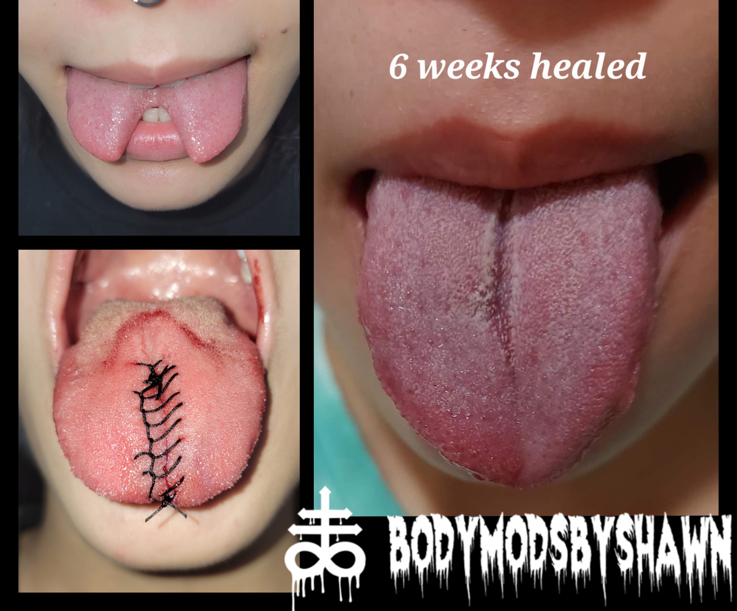 Tongue Split Reversal Body Mods By Shawn